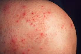 Can depression/anxiety cause allergic skin rashes?