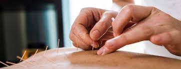 Surprising Solution for Chronic Foot Pain: Acupuncture for Foot Pain Near Me