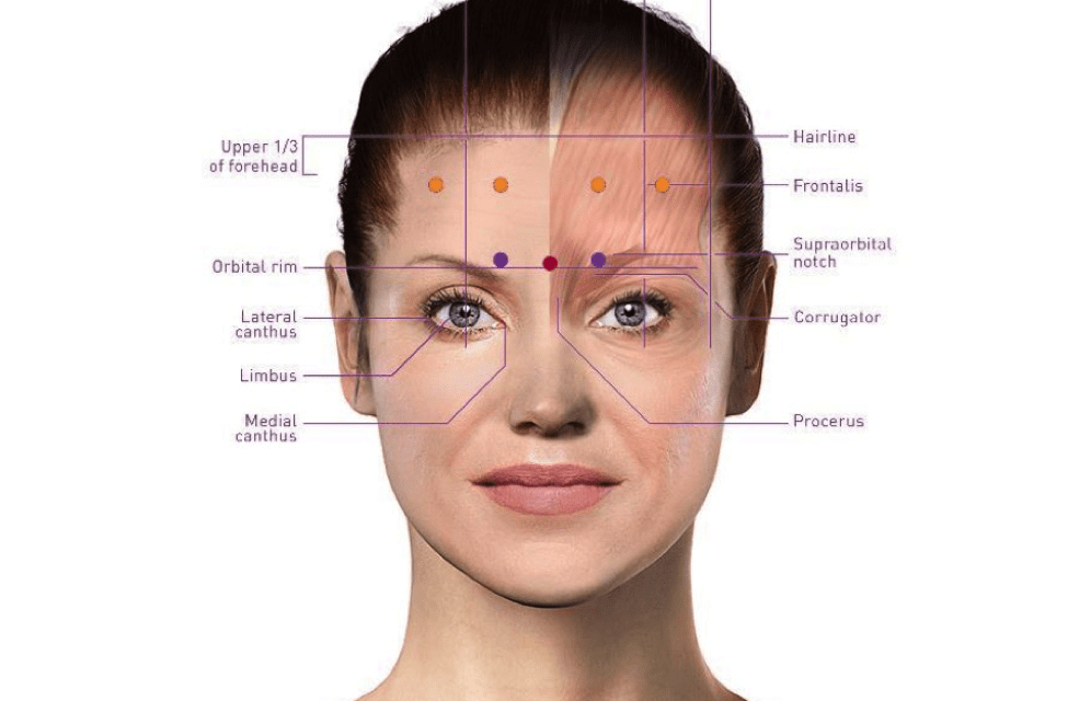 Have you had Botox for migraines? Did it work?