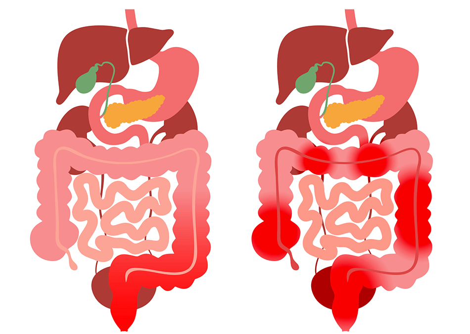 Nutrition Tips for Inflammatory Bowel Disease (IBD)