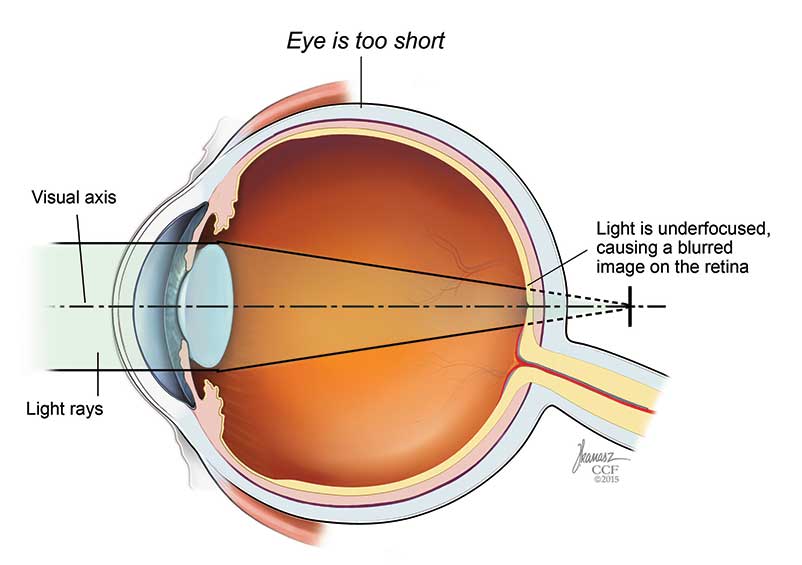 Understanding Astigmatism: Causes, Symptoms, and Treatment