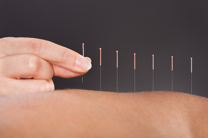 Addressing The Commonly Asked Questions Regarding Acupuncture Treatments in Kids.