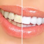 Teeth Whitening Technology and Ingredients
