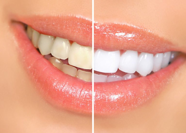 Teeth Whitening Technology and Ingredients