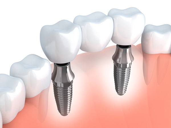 Get Your Smile Back: The Benefits of a Front Tooth Implant