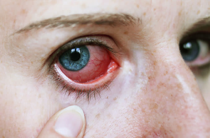 Understanding Uveitis: Causes, Symptoms, and Prevention