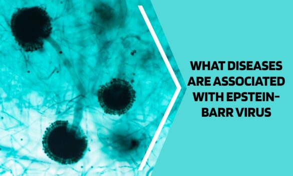 what diseases are associated with epstein-barr virus