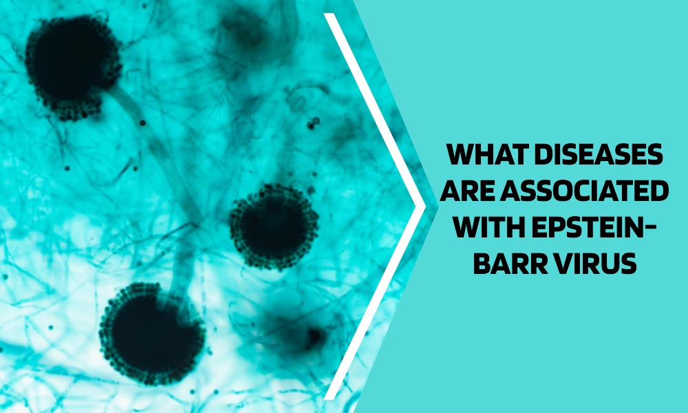 What Diseases are Associated with the Epstein-Barr Virus